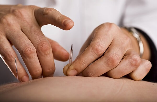 Hiệu quả của châm cứu trong trị thoái hóa đốt sống